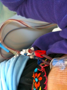 IMG_0170 Obviously they used my LTS line for the harvesting. Blood went into the machine from one of the catheter ends (blue) and then came back to me via the machine through the catheter on the right.